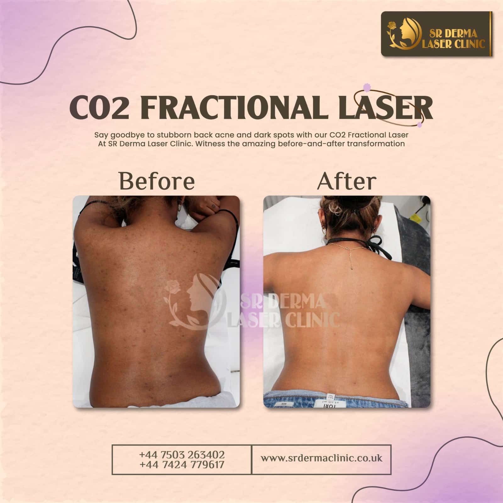 Instagram Before after