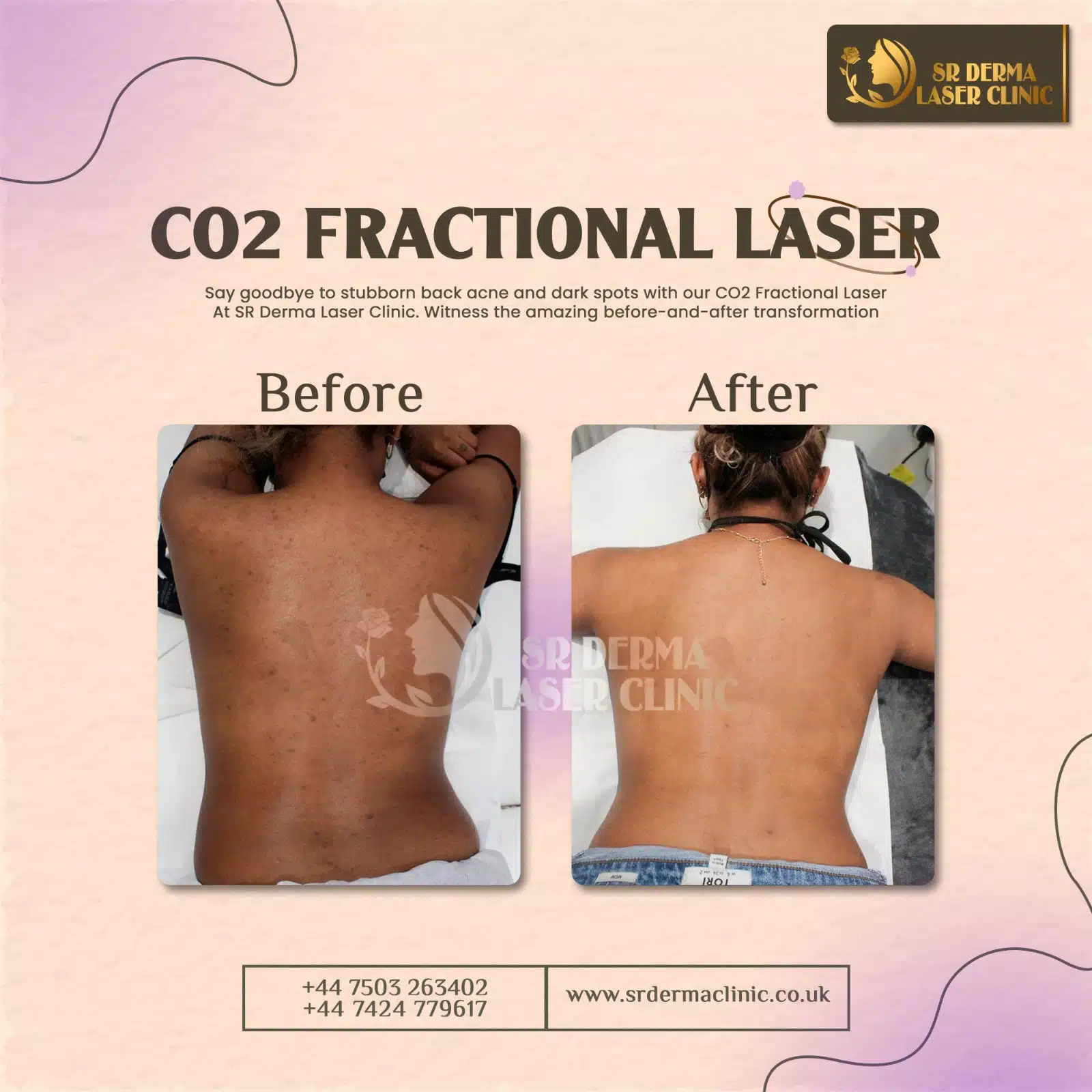 Instagram Before after