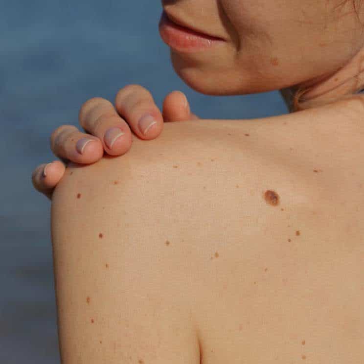 Cryotherapy Expert | SR Derma Laser Clinic