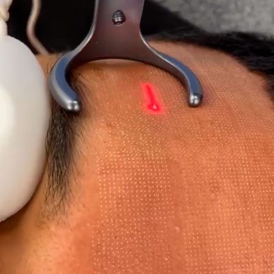 Fraction CO2 Laser treatment | SR Derma Laser Clinic