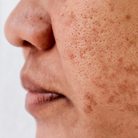 Dark SpotS treatment| SR Derma Laser Clinic