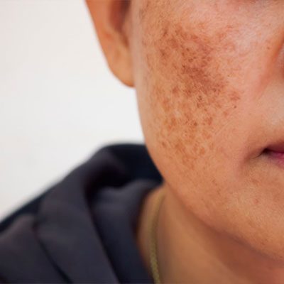 melasma treatment | SR Derma Laser Clinic