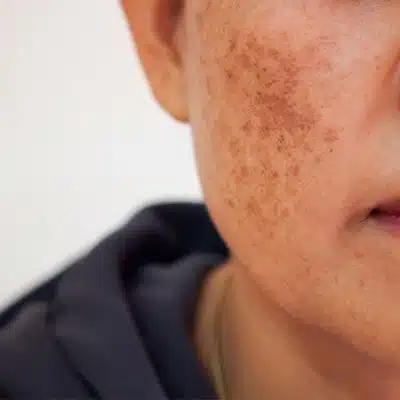 melasma treatment | SR Derma Laser Clinic