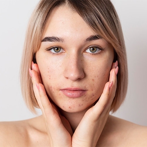 Hyperpigmentation Treatment at SR Derma Laser Clinic