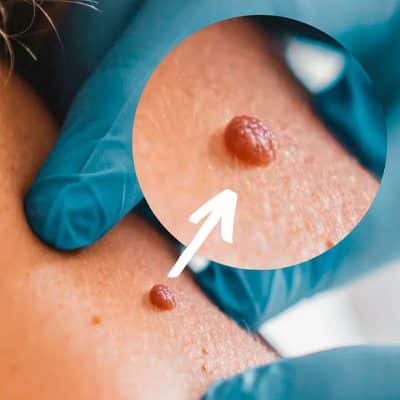 Skin Tags Removal | SR Derma Laser Clinic